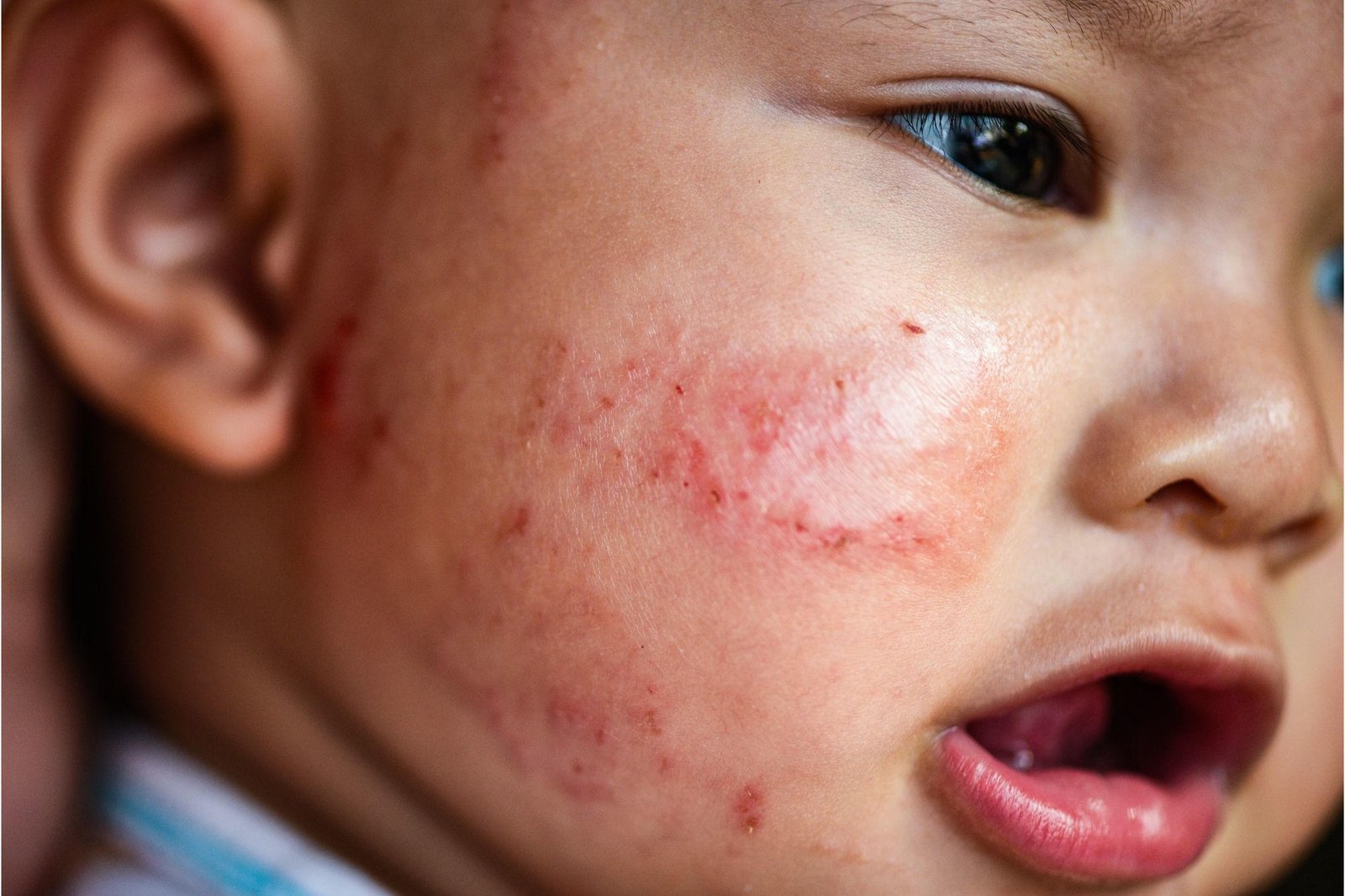 Pioneering Study Suggests Vaccines Could End Eczema’s Itch for Good