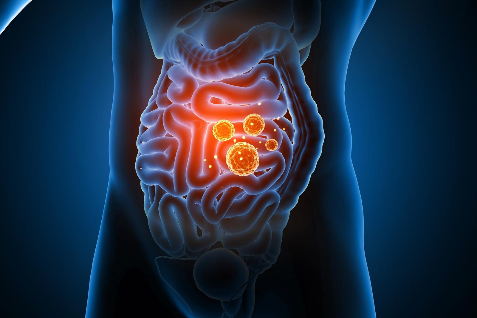 Largest Study of Its Kind Finds Gut Microbes Linked to Type 2 Diabetes