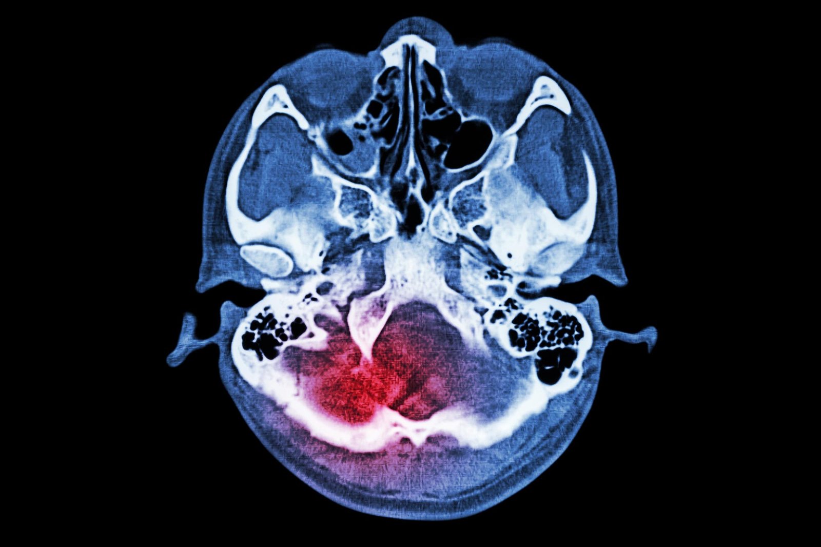 The Transformative Power of LK-2 in Stroke Treatment