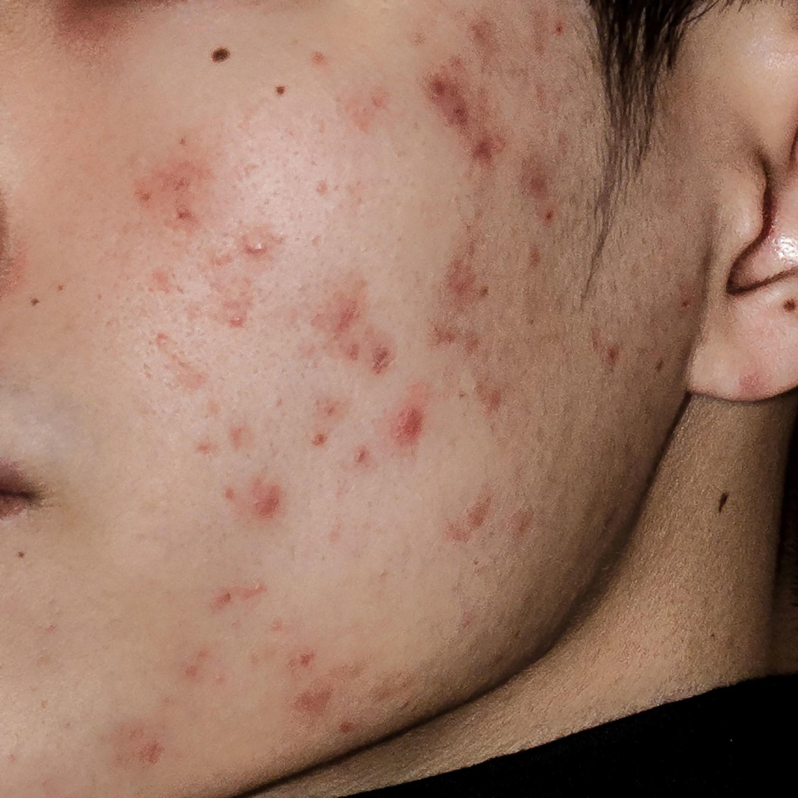 Scientists Discover New Natural Anti-Acne Solution